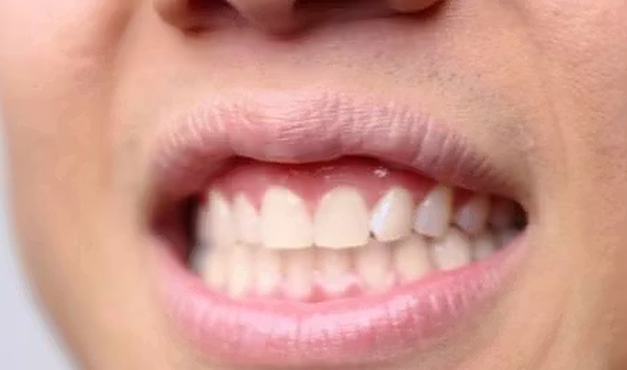 Filip Thain hampaat ennen
